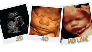 HD ultrasound